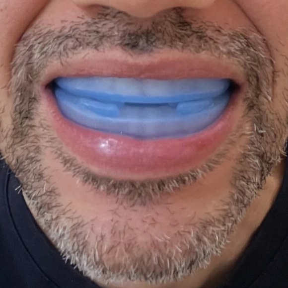 Znorex Anti-Ronco — protetor bucal posicionado na boca